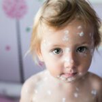 Chickenpox in children: symptoms, duration and treatment