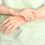 Što je to reaktivni artritis?