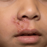 Impetigo kod djece