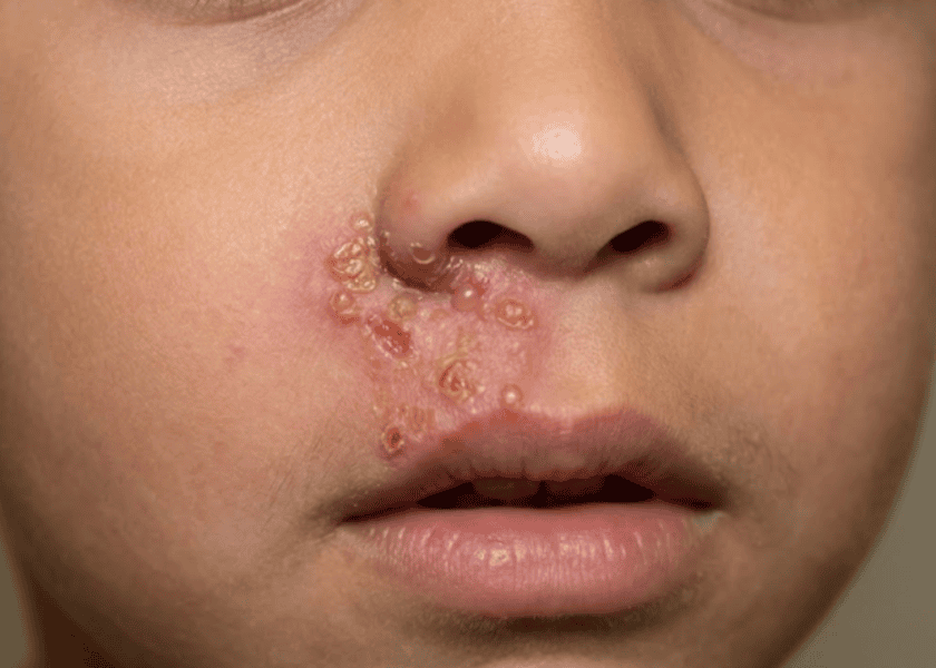 impetigo